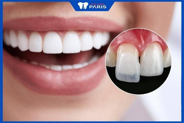 5 Kinh nghiệm dán răng sứ Veneer không nên bỏ qua